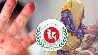 হামের উপসর্গে আরও তিনজনের মৃত্যু